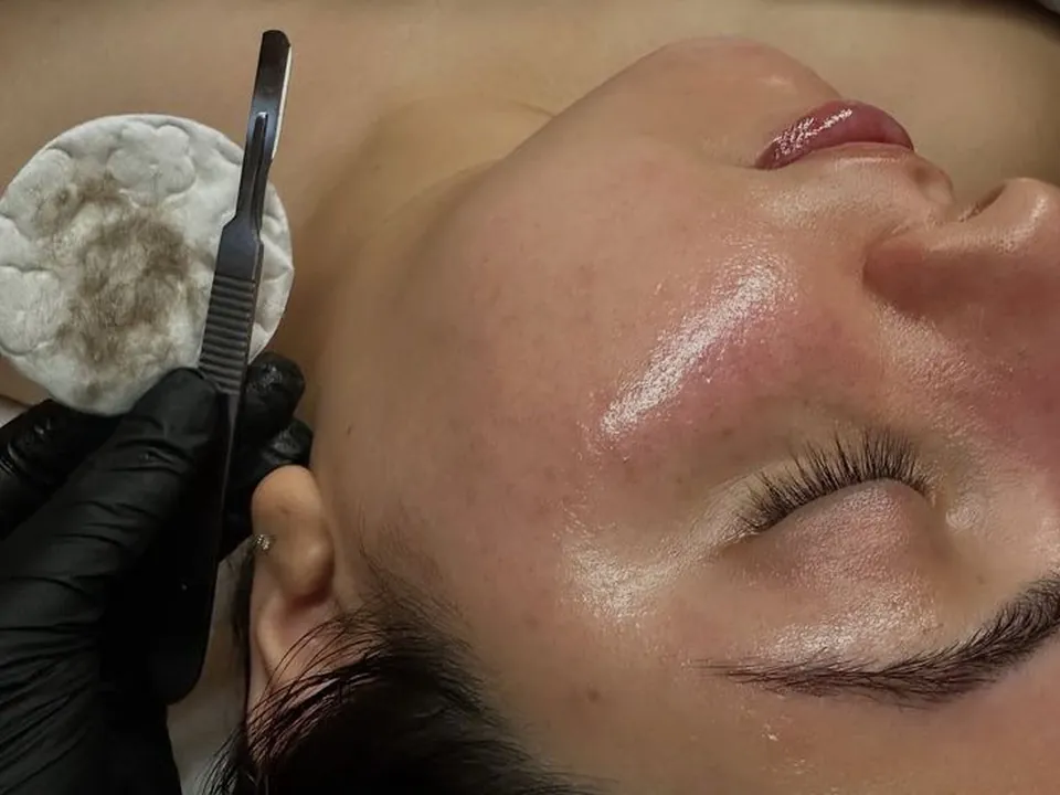 Limpieza facial con dermaplaning en CADII Estética Lanús